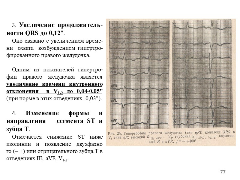 77 3. Увеличение продолжитель-ности QRS до 0,12 77 3. Увеличение продолжитель-ности QRS до 0,12
